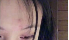 挤痘痘视频,专业视频教你正确操作